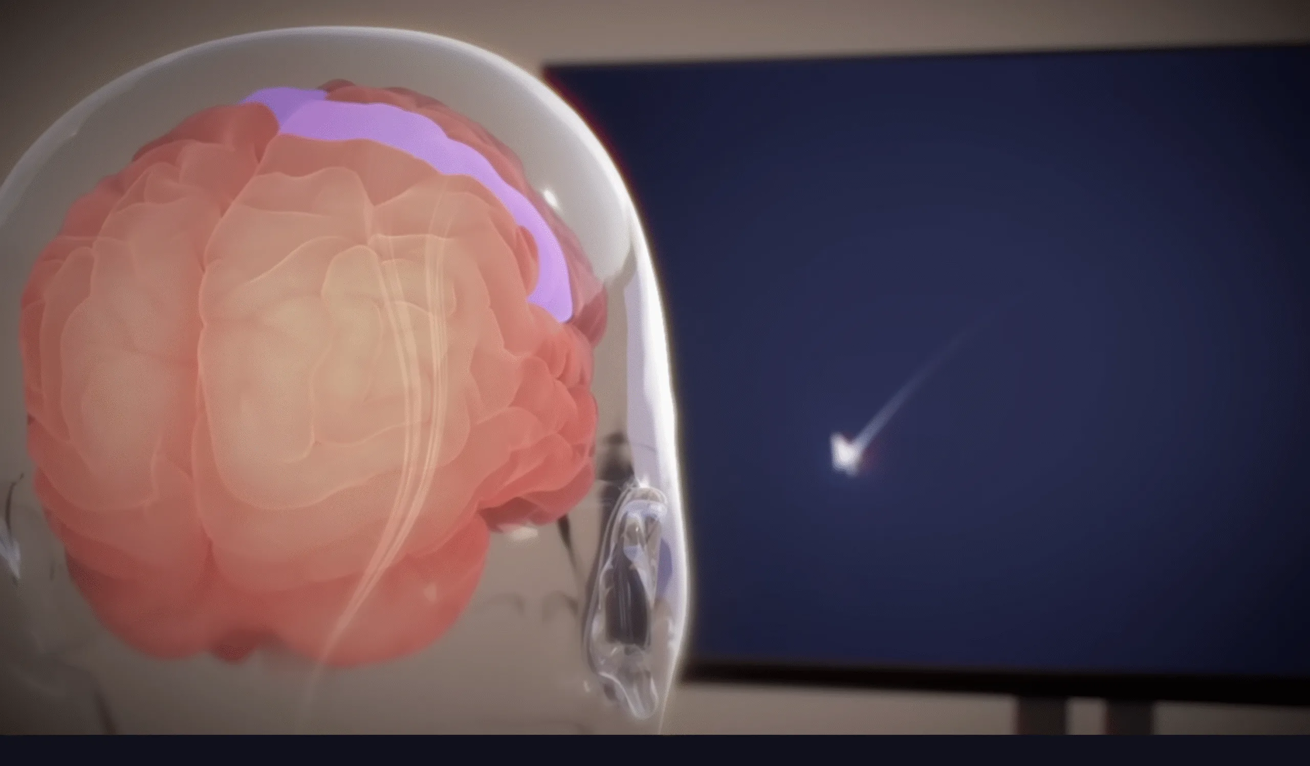 Neuralink: Ασθενής παίζει World of Warcraft 